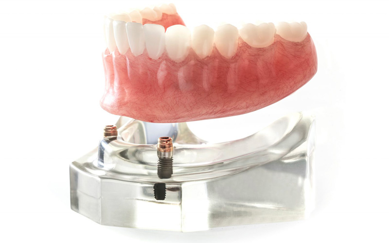 Over Dentures / Snap-On Teeth