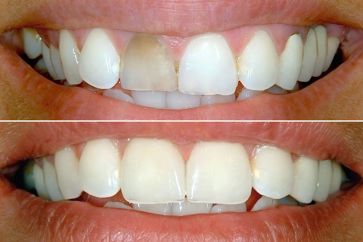 zuba izbeljivanje bleaching trajanje iskustva preparati metode dentistry cosmetic zub