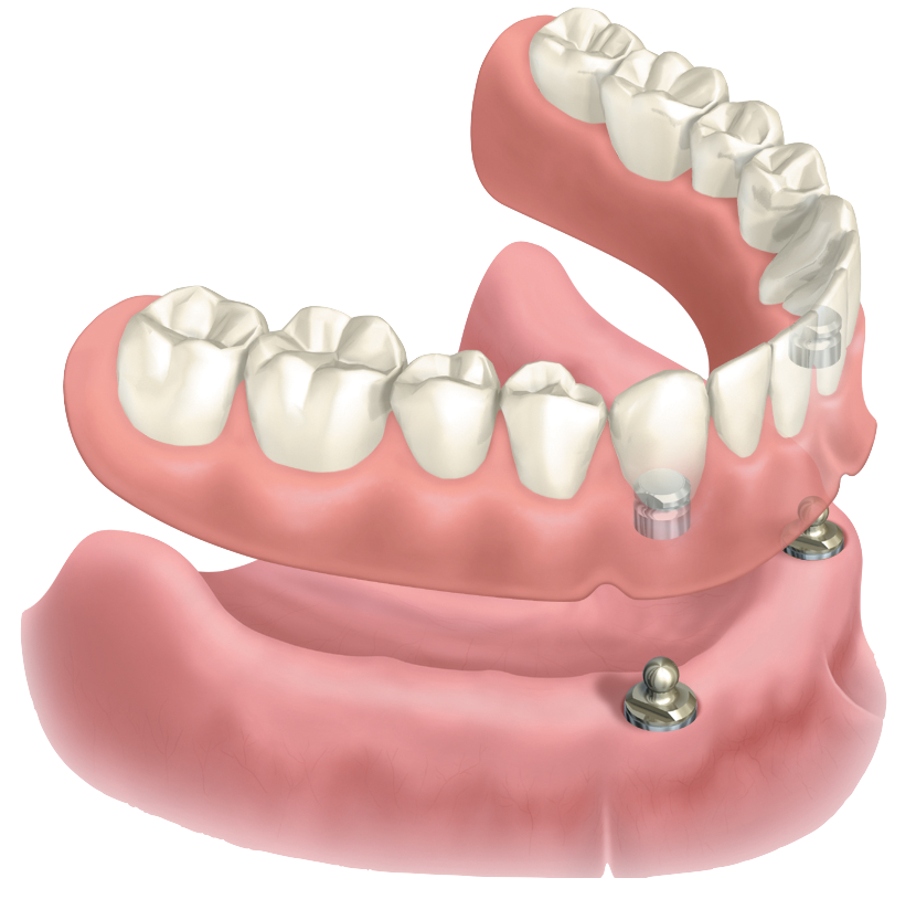 overdentures / snap-on teeth
